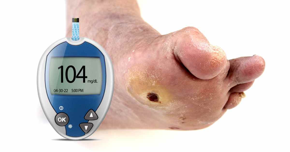 Find Effective Treatments for Diabetic Wounds and Ulcers