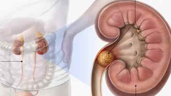 क्या आप पाइल्स से परेशान हैं? यहां जानिए सब कुछ