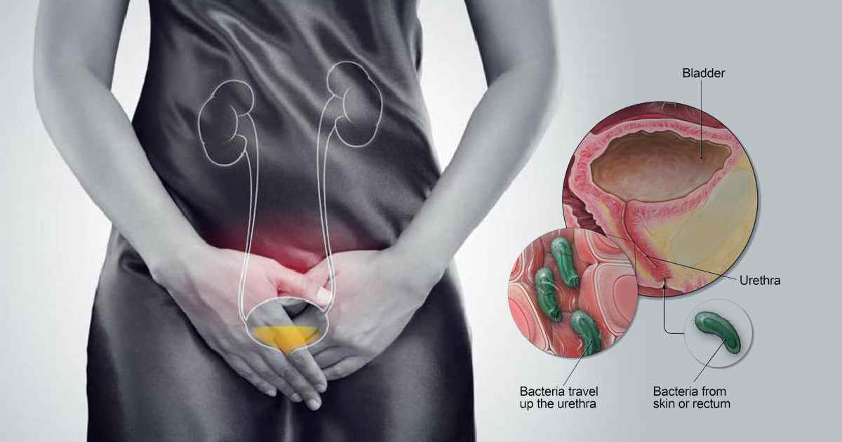 Urinary Stones: Everything You Always Wanted to Know