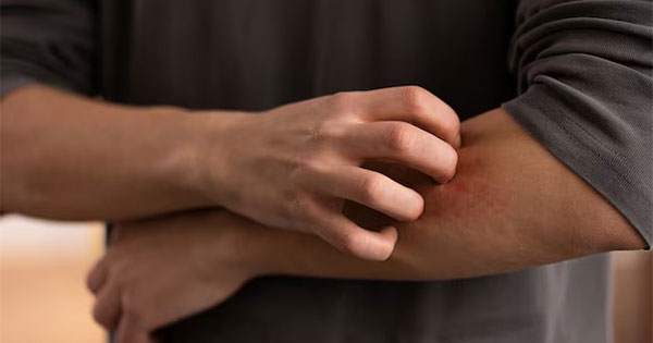 How to Choose the Best Antifungal Cream in India for Your Needs